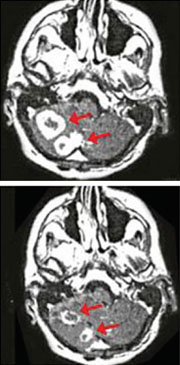 brain_cancer brain_cancer