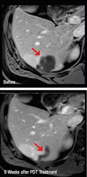 liver_cancer liver_cancer